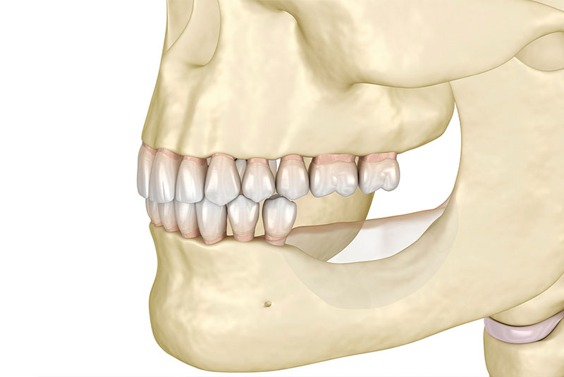 bone loss