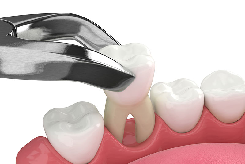 teeth removal